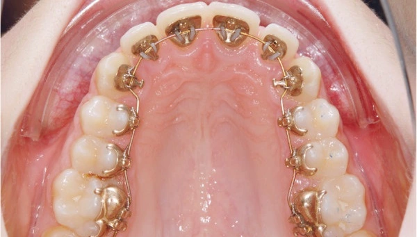 Self Ligating Braces