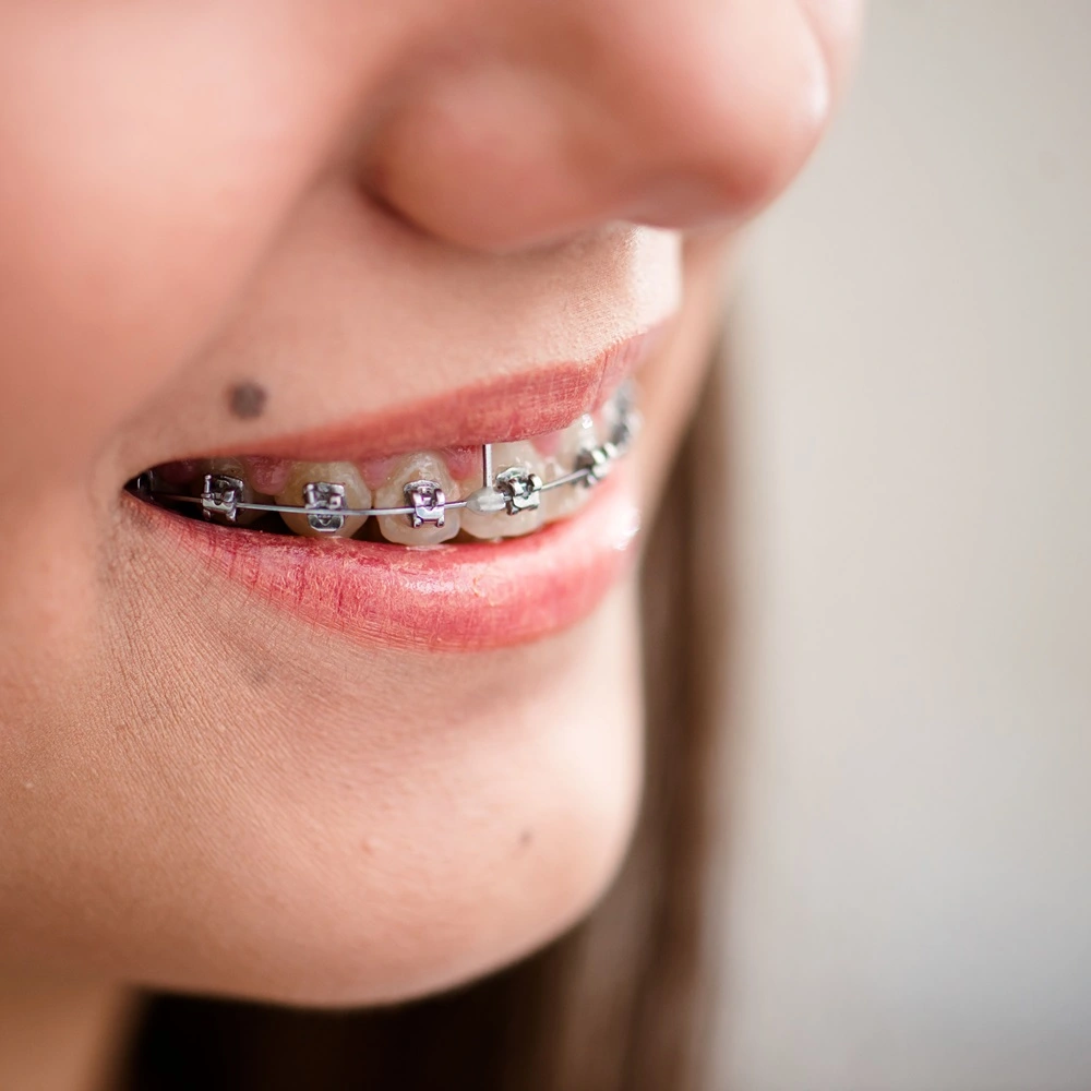 Braces/Orthodontics Image