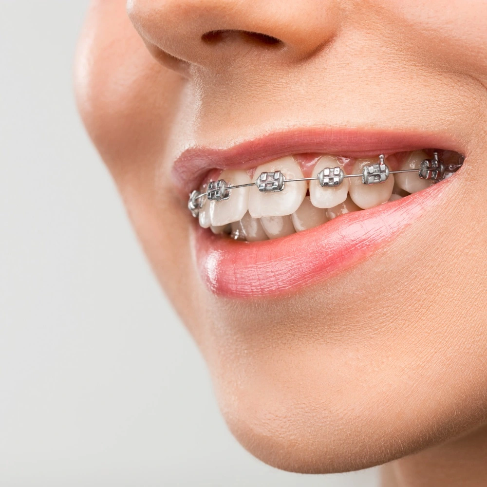 Braces/Orthodontics Image