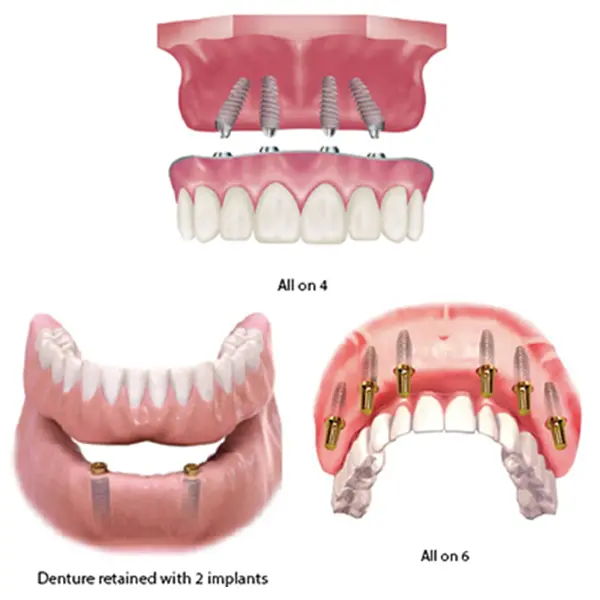 best dental implant clinic near me gurgaon